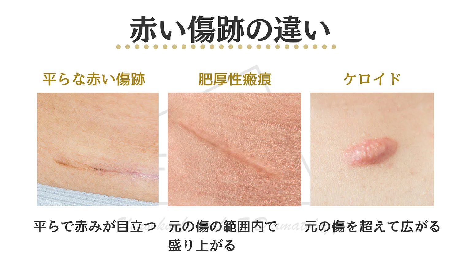 3つの赤い傷跡の患部写真
